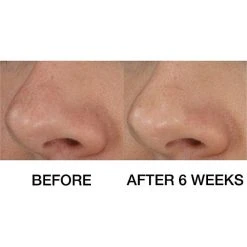 Clinique Blackhead Solutions Self-Heating Blackhead Extractor 13 Clinique Blackhead Solutions Self-Heating Blackhead Extractor -Bobbi Brown sales 05838684 02 ai