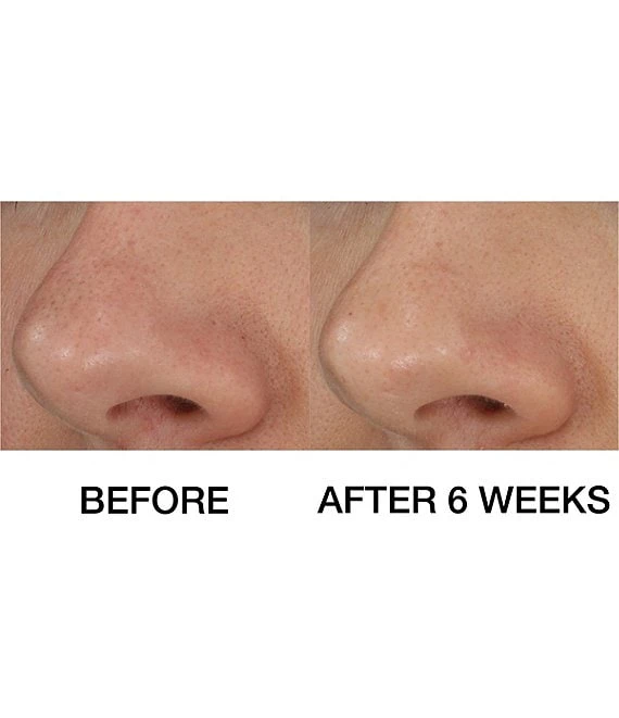 Clinique Blackhead Solutions Self-Heating Blackhead Extractor 8 Clinique Blackhead Solutions Self-Heating Blackhead Extractor - Afbeelding 6